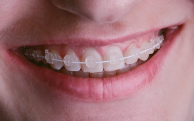 They’re Growing Up Quickly: What is the Best Age to Get Braces?