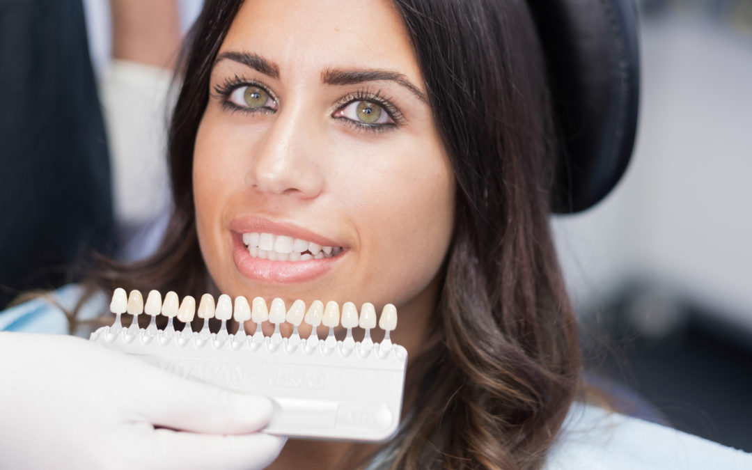 Pearly Whites: 7 Things You Should Know About Porcelain Veneers