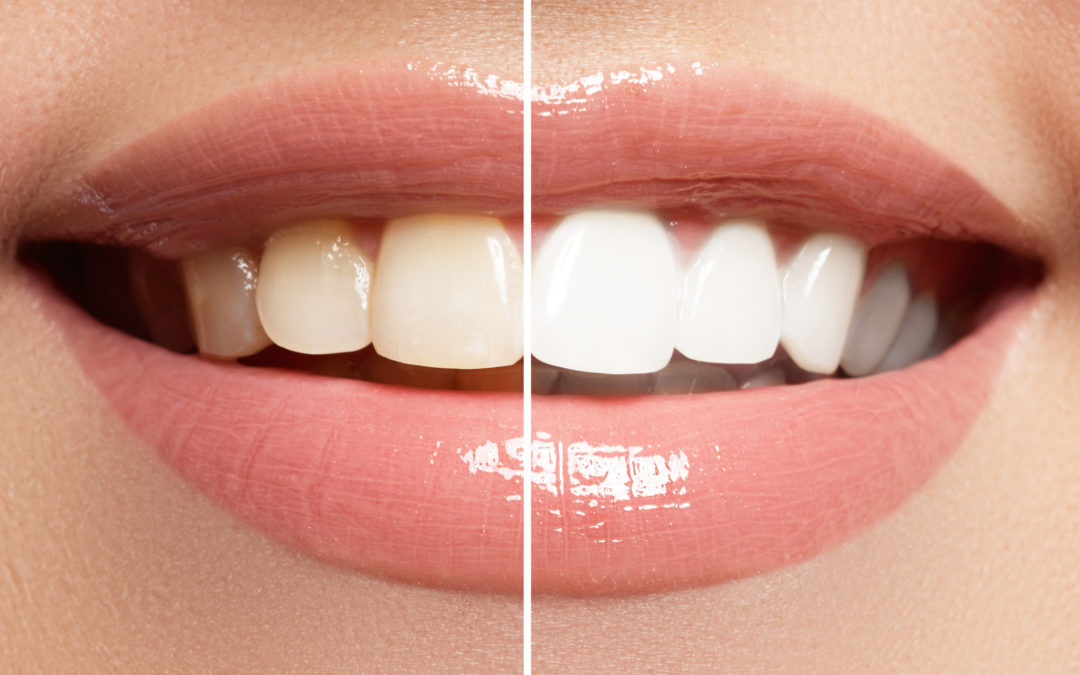 How to Whiten Your Yellow Teeth: 3 Options to Consider