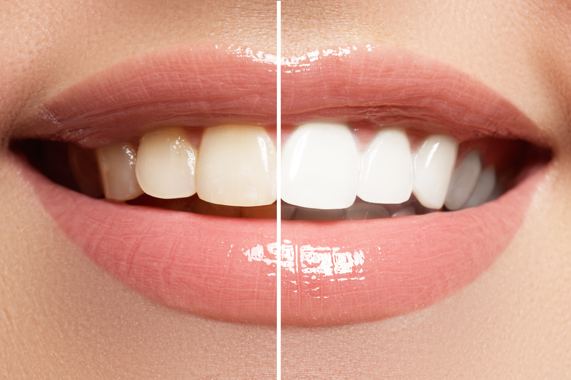 How to Whiten Your Yellow Teeth 3 Options to Consider